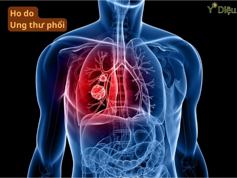 Ho do ung thư phổi: Dấu hiệu cảnh báo không nên bỏ qua